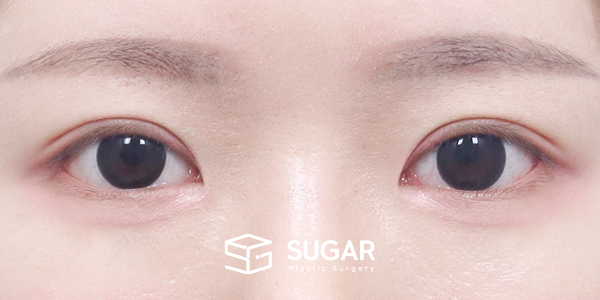 SUGAR整形外科 術前術後案例 #1284 術前術後照片 - 術後