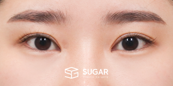 SUGAR整形外科 術前術後案例 #1266 術前術後照片 - 術前