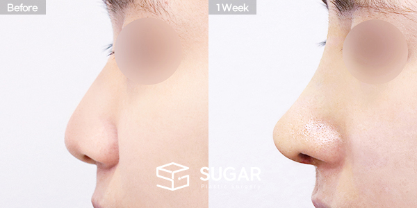 SUGAR整形外科 術前術後案例 #1466 術前術後照片 - 側面術前術後比較