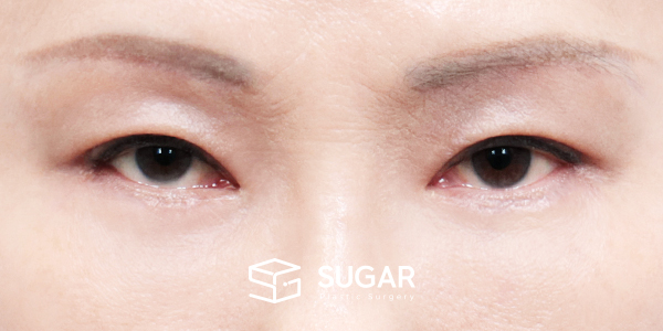 SUGAR整形外科 術前術後案例 #1450 術前術後照片 - 術後