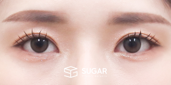 SUGAR整形外科 術前術後案例 #1205 術前術後照片 - 術後