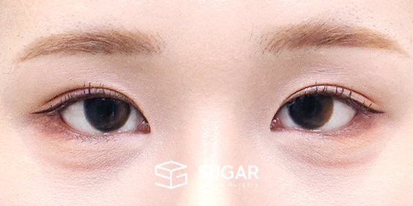 SUGAR整形外科 術前術後案例 #1449 術前術後照片 - 術後