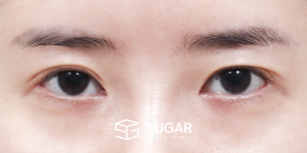 SUGAR整形外科 術前術後案例 #1275 術前術後照片 - 術前