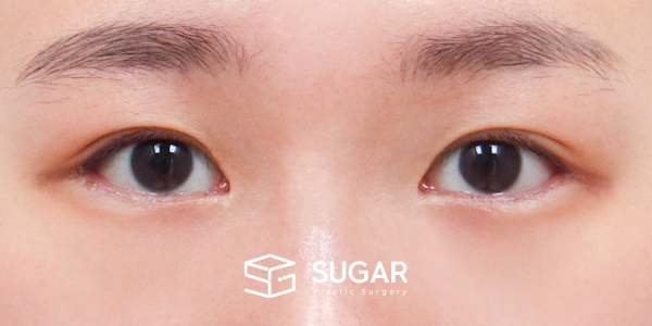 SUGAR整形外科 術前術後案例 #1185 術前術後照片 - 術後