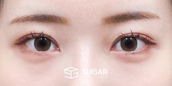 SUGAR整形外科 術前術後案例 #1176 術前術後照片 - 術後