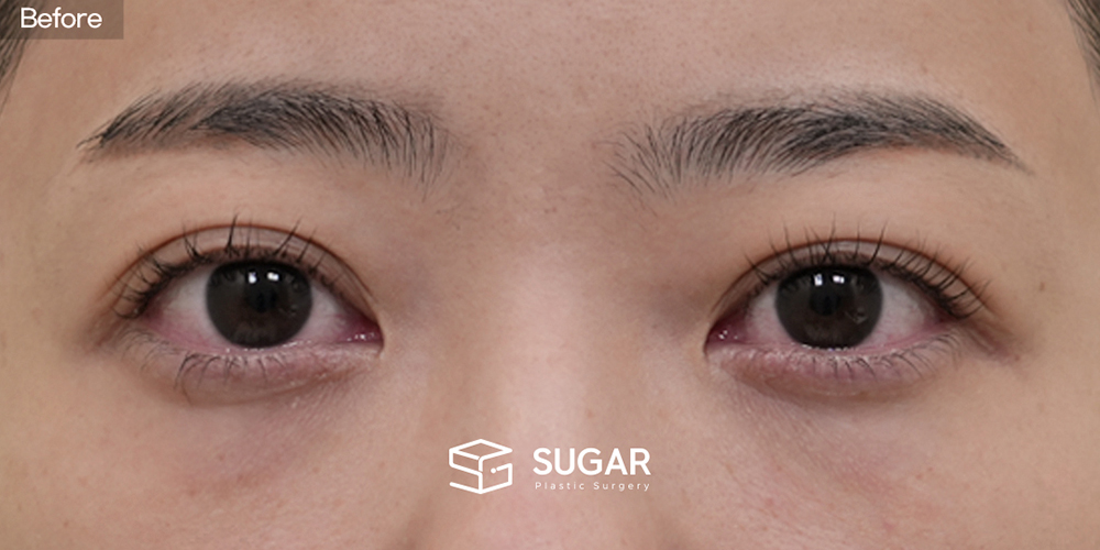 SUGAR整形外科 初次) 眼下脂肪重新分布 + 額頭拉提 + 無假體隆鼻 + 自體肋軟骨 + 鼻翼縮小 + 蒜頭鼻 + 鼻柱延長 術前術後照片 - 術前