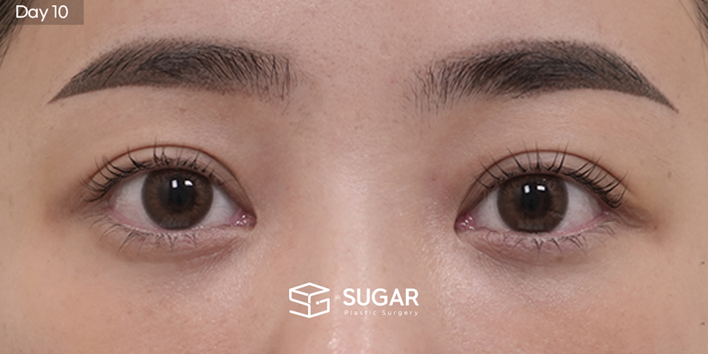 SUGAR整形外科 初次) 眼下脂肪重新分布 + 額頭拉提 + 無假體隆鼻 + 自體肋軟骨 + 鼻翼縮小 + 蒜頭鼻 + 鼻柱延長 術前術後照片 - 術後