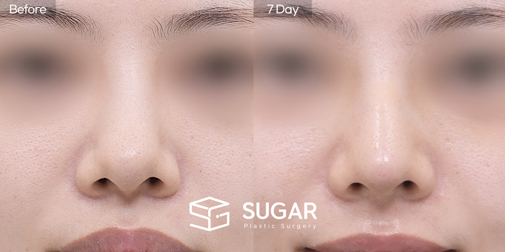SUGAR整形外科 初次) 鼻樑 + 鼻尖 + 鼻中膈 + 耳軟骨 + 異體肋軟骨 + 鼻柱延長 + 蒜頭鼻 術前術後照片 - 正面術前術後比較