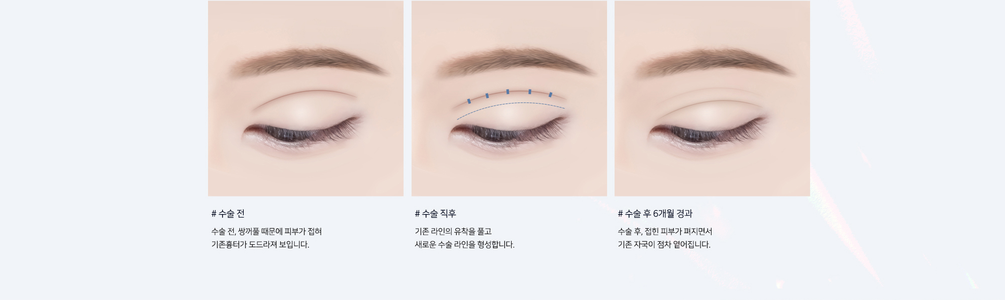 # 수술 전 : 수술 전, 쌍꺼풀 때문에 피부가 접혀 기존흉터가 도드라져 보입니다.   # 수술 직후 : 기존 라인의 유착을 풀고 새로운 수술 라인을 형성합니다.   # 수술 후 6개월 경과 : 수술 후, 접힌 피부가 펴지면서 기존 자국이 점차 옅어집니다.