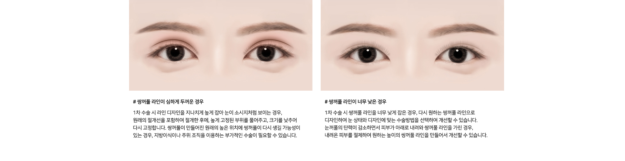 # 쌍꺼풀 라인이 심하게 두꺼운 경우 : 1차 수술 시 라인 디자인을 지나치게 높게 잡아 눈이 소시지처럼 보이는 경우, 원래의 절개선을 포함하여 절개한 후에, 높게 고정된 부위를 풀어주고, 크기를 낮추어 다시 고정합니다. 쌍꺼풀이 만들어진 원래의 높은 위치에 쌍꺼풀이 다시 생길 가능성이 있는 경우, 지방이식이나 주위 조직을 이용하는 부가적인 수술이 필요할 수 있습니다.   /   # 쌍꺼풀 라인이 너무 낮은 경우 : 1차 수술 시 쌍꺼풀 라인을 너무 낮게 잡은 경우, 다시 원하는 쌍꺼풀 라인으로 디자인하여 눈 상태와 디자인에 맞는 수술방법을 선택하여 개선할 수 있습니다. 눈꺼풀의 탄력이 감소하면서 피부가 아래로 내려와 쌍꺼풀 라인을 가린 경우, 내려온 피부를 절제하여 원하는 높이의 쌍꺼풀 라인을 만들어서 개선할 수 있습니다.
