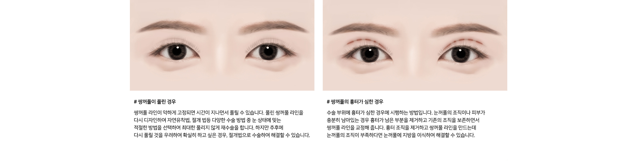 # 쌍꺼풀이 풀린 경우 : 쌍꺼풀 라인이 약하게 고정되면 시간이 지나면서 풀릴 수 있습니다. 풀린 쌍꺼풀 라인을 다시 디자인하여 자연유착법, 절개 법등 다양한 수술 방법 중 눈 상태에 맞는 적절한 방법을 선택하여 최대한 풀리지 않게 재수술을 합니다. 하지만 추후에 다시 풀릴 것을 우려하여 확실히 하고 싶은 경우, 절개법으로 수술하여 해결할 수 있습니다.   # 쌍꺼풀의 흉터가 심한 경우 : 수술 부위에 흉터가 심한 경우에 시행하는 방법입니다. 눈꺼풀의 조직이나 피부가 충분히 남아있는 경우 흉터가 남은 부분을 제거하고 기존의 조직을 보존하면서 쌍꺼풀 라인을 교정해 줍니다. 흉터 조직을 제거하고 쌍꺼풀 라인을 만드는데 눈꺼풀의 조직이 부족하다면 눈꺼풀에 지방을 이식하여 해결할 수 있습니다.