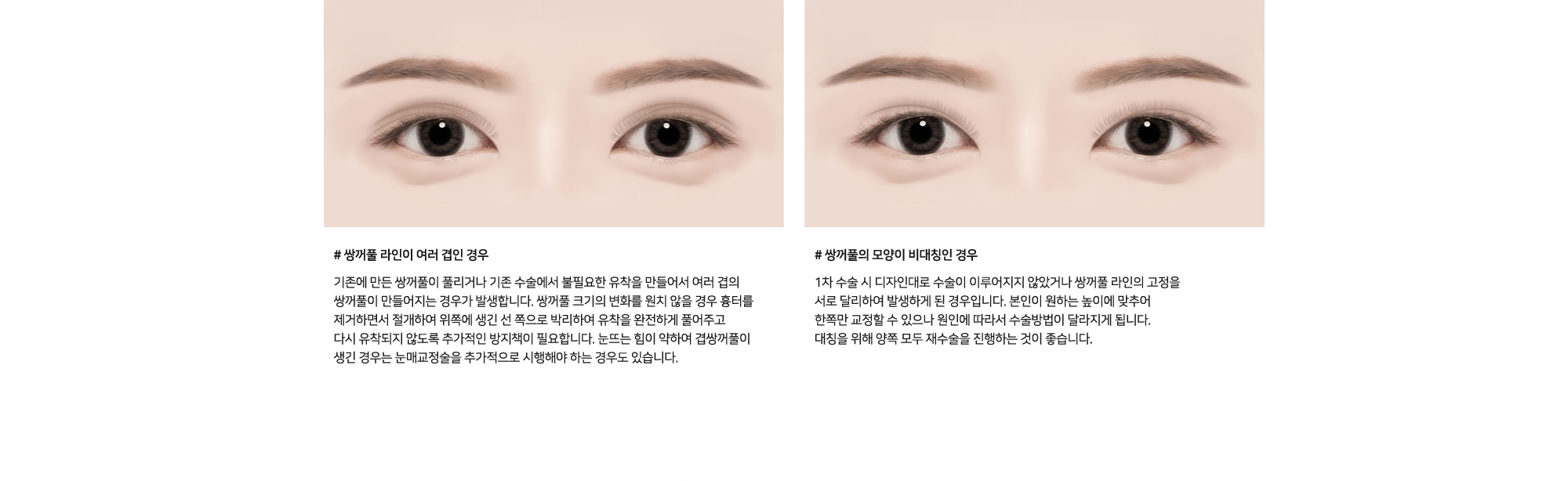 # 쌍꺼풀 라인이 여러 겹인 경우 : 기존에 만든 쌍꺼풀이 풀리거나 기존 수술에서 불필요한 유착을 만들어서 여러 겹의 쌍꺼풀이 만들어지는 경우가 발생합니다. 쌍꺼풀 크기의 변화를 원치 않을 경우 흉터를 제거하면서 절개하여 위쪽에 생긴 선 쪽으로 박리하여 유착을 완전하게 풀어주고 다시 유착되지 않도록 추가적인 방지책이 필요합니다. 눈뜨는 힘이 약하여 겹쌍꺼풀이 생긴 경우는 눈매교정술을 추가적으로 시행해야 하는 경우도 있습니다.   # 쌍꺼풀의 모양이 비대칭인 경우 : 1차 수술 시 디자인대로 수술이 이루어지지 않았거나 쌍꺼풀 라인의 고정을 서로 달리하여 발생하게 된 경우입니다. 본인이 원하는 높이에 맞추어 한쪽만 교정할 수 있으나 원인에 따라서 수술방법이 달라지게 됩니다. 대칭을 위해 양쪽 모두 재수술을 진행하는 것이 좋습니다.