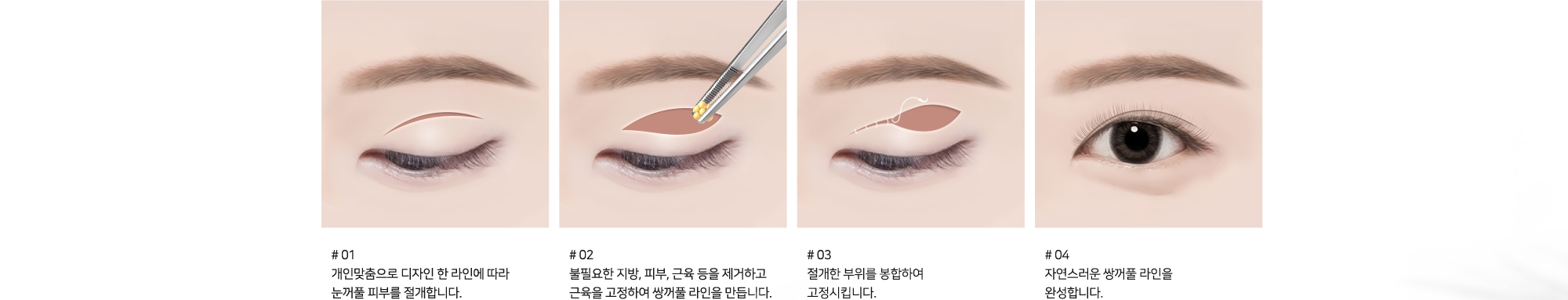 #01 개인맞춤으로 디자인 한 라인에 따라 눈꺼풀 피부를 절개합니다. #02 불필요한 지방, 피부, 근육 등을 제거하고 근육을 고정하여 쌍꺼풀 라인을 만듭니다. #03 절개한 부위를 봉합하여 고정시킵니다. #04 자연스러운 쌍꺼풀 라인을 완성합니다.