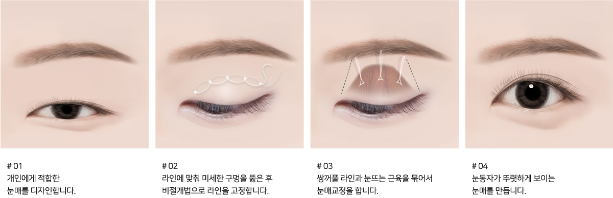 비절개 눈매교정 수술방법 - #01 개인에게 적합한 눈매를 디자인합니다. #02 라인에 맞춰 미세한 구멍을 뚫은 후 비절개법으로 라인을 고정합니다. #03 쌍꺼풀 라인과 눈뜨는 근육을 묶어서 눈매교정을 합니다. #04 눈동자가 뚜렷하게 보이는 눈매를 만듭니다.