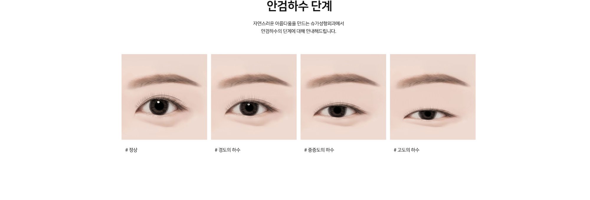 안검하수 단계 - 자연스러운 아름다움을 만드는 슈가성형외과에서 안검하수의 단계에 대해 안내해드립니다. # 정상 # 경도의 하수 # 중증도의 하수 # 고도의 하수