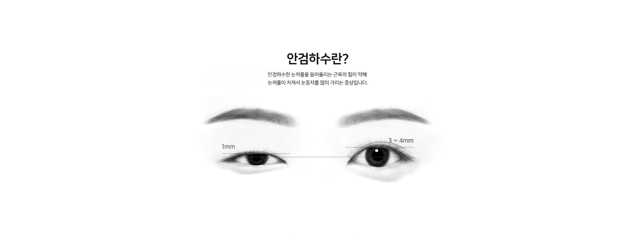 안검하수란? - 안검하수란 눈꺼풀을 들어올리는 근육의 힘이 약해 눈꺼풀이 처져서 눈동자를 많이 가리는 증상입니다. (1mm, 3~4mm 비교)