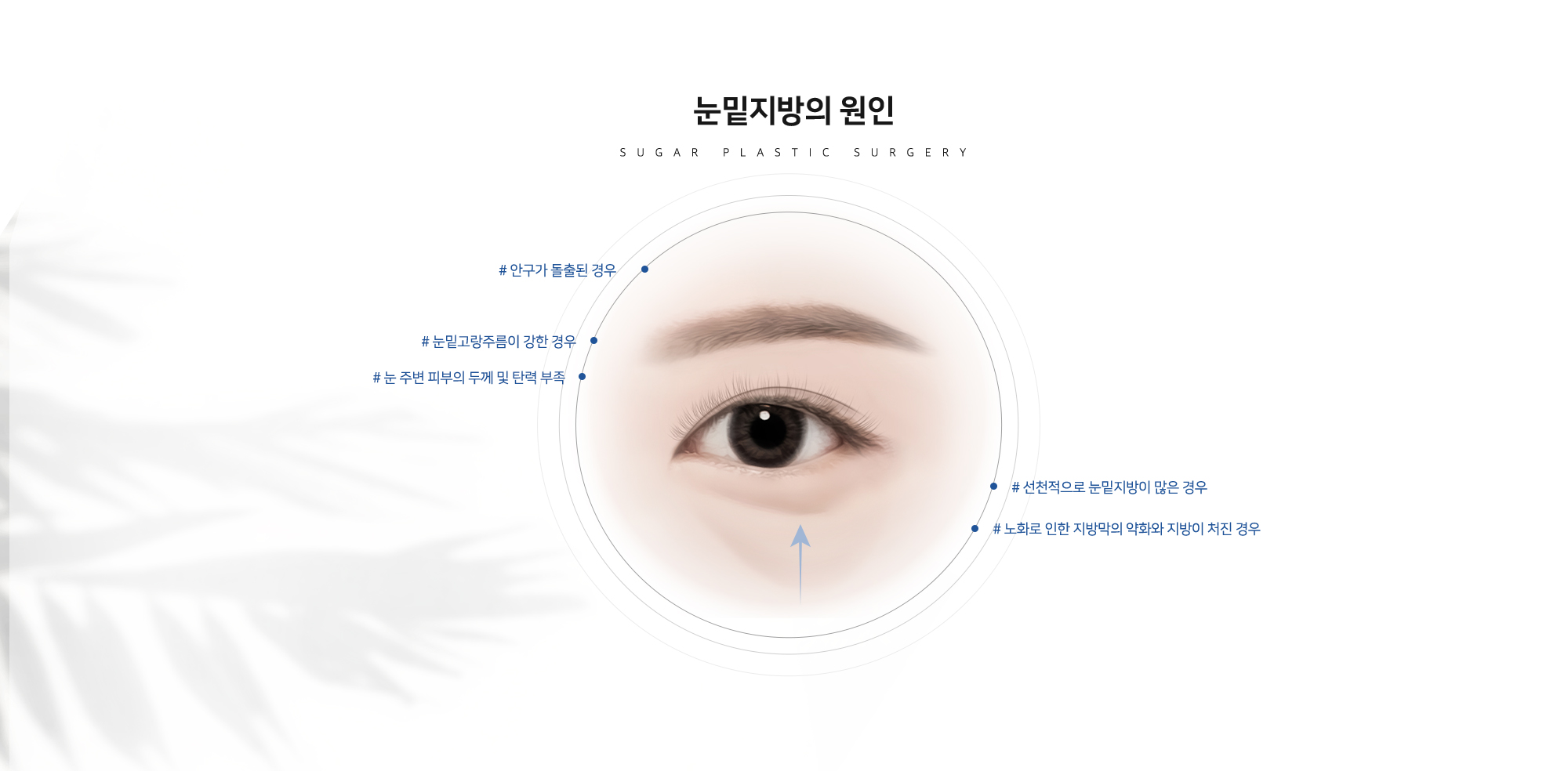 눈밑지방의 원인 - SUGAR PLASTIC SURGERY # 안구가 돌출된 경우 # 눈밑고랑주름이 강한 경우 # 눈 주변 피부의 두께 및 탄력 부족 # 선천적으로 눈밑지방이 많은 경우 # 노화로 인한 지방막의 약화와 지방이 처진 경우