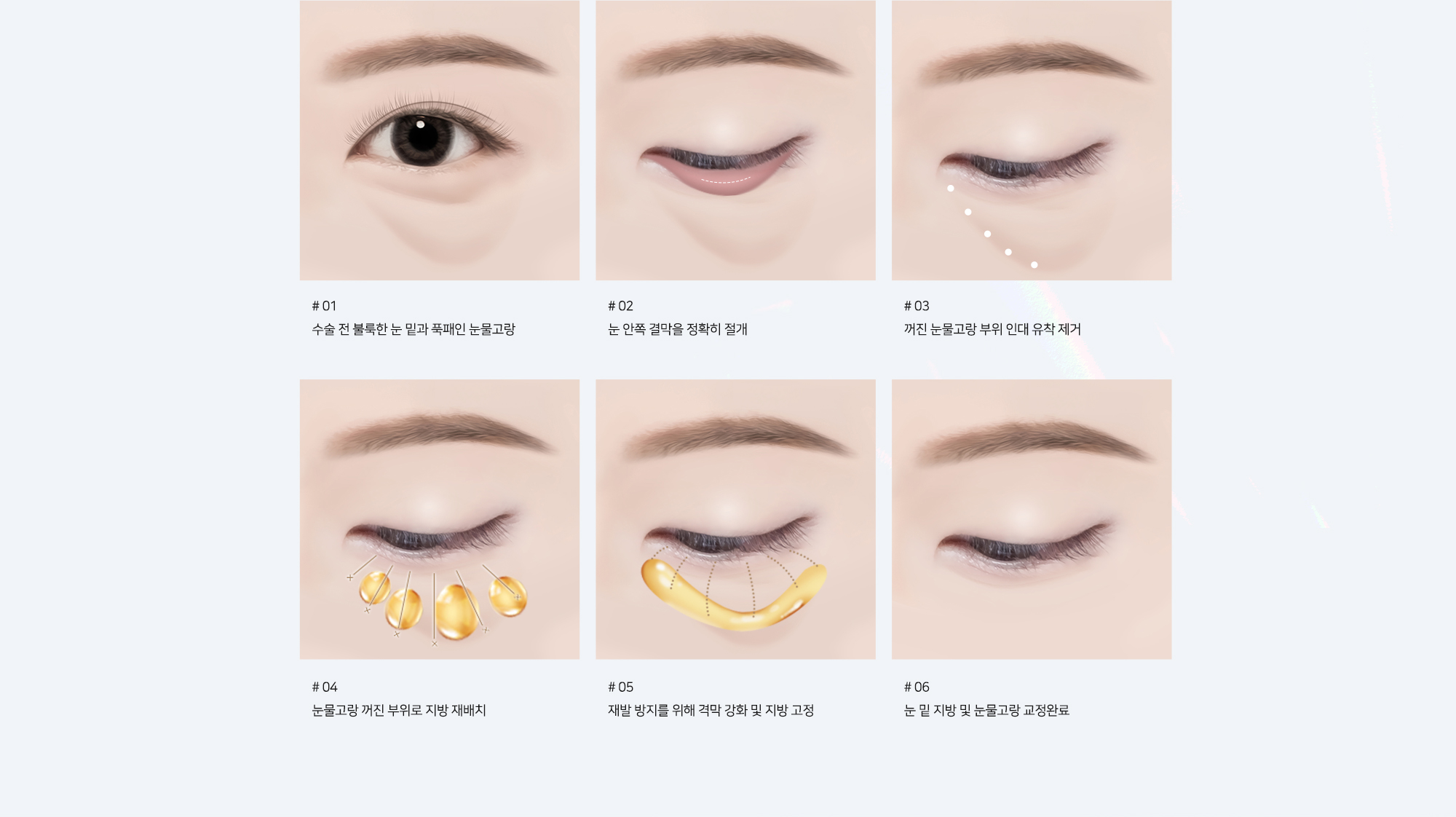 #01 수술 전 불룩한 눈 밑과 푹패인 눈물고랑 #02 눈 안쪽 결막을 정확히 절개 #03 꺼진 눈물고랑 부위 인대 유착 제거 #04 눈물고랑 꺼진 부위로 지방 재배치 #05 재발 방지를 위해 격막 강화 및 지방 고정 #06 눈 밑 지방 및 눈물고랑 교정완료