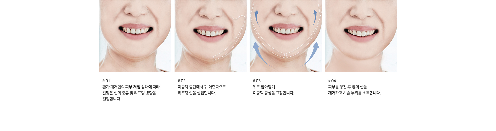 [이중턱 실리프팅 수술방법] # 01 환자 개개인의 피부 처짐 상태에 따라 알맞은 실의 종류 및 리프팅 방향을 결정합니다. # 02 이중턱 중간에서 귀 아래쪽으로 리프팅 실을 삽입합니다. # 03 위로 잡아당겨 이중턱 증상을 교정합니다. # 04 피부를 당긴 후 밖의 실을 제거하고 시술 부위를 소독합니다.
