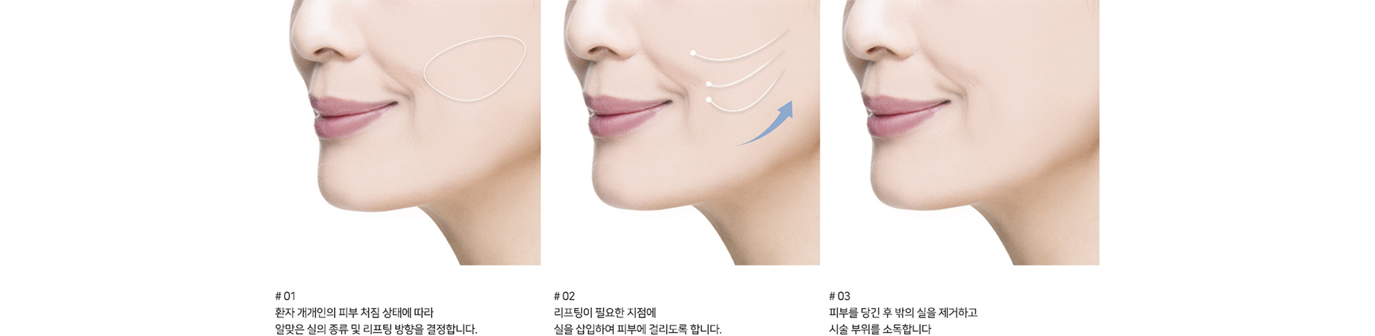 [리프팅 시술 방법] # 01 환자 개개인의 피부 처짐 상태에 따라 알맞은 실의 종류 및 리프팅 방향을 결정합니다. # 02 리프팅이 필요한 지점에 실을 삽입하여 피부에 걸리도록 합니다. # 03 피부를 당긴 후 밖의 실을 제거하고 시술 부위를 소독합니다.