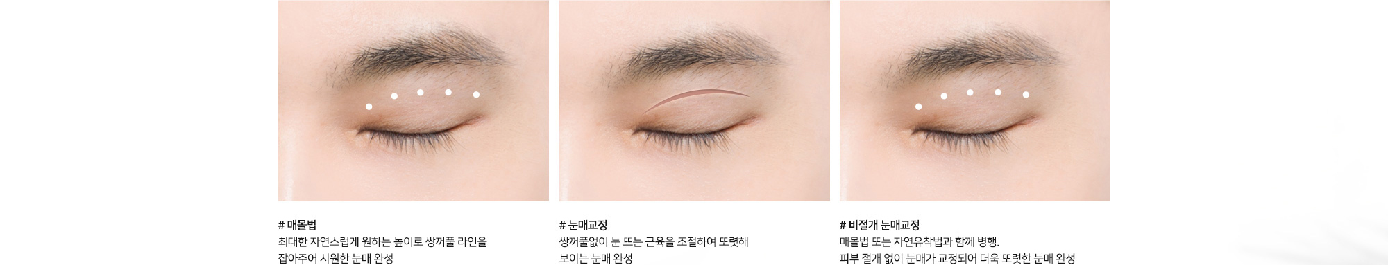 [남자눈성형 수술방법] # 매몰법 최대한 자연스럽게 원하는 높이로 쌍꺼풀 라인을 잡아주어 시원한 눈매 완성 # 눈매교정 쌍꺼풀없이 눈 뜨는 근육을 조절하여 또렷해 보이는 눈매 완성 # 비절개 눈매교정 매몰법 또는 자연유착법과 함께 병행 피부 절개 없이 눈매가 교정되어 더욱 또렷한 눈매 완성