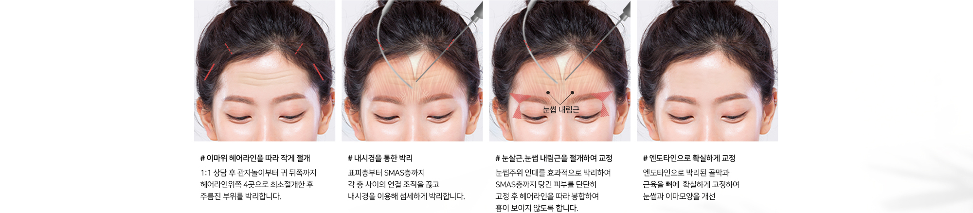 [내시경 이마거상술 수술방법] # 이마 위 헤어라인을 따라 작게 절개 1:1 상담 후 관자놀이부터 귀 뒤쪽까지 헤어라인 위쪽 4곳으로 최소 절개한 후 주름진 부위를 박리합니다. # 내시경을 통한 박리 표피층부터 SMAS층까지 각 층 사이의 연결 조직을 끊고 내시경을 이용해 섬세하게 박리합니다. # 눈살근, 눈썹 내림근을 절개하여 교정 눈썹주위 인대를 효과적으로 박리하여 SMAS층까지 당긴 피부를 단단히 고정 후 헤어라인 따라 봉합하여 흉이 보이지 않도록 합니다. # 엔도타인으로 확실하게 교정 엔도타인으로 박리된 골막과 근육을 뼈에 확실하게 고정하여 눈썹과 이마모양을 개선