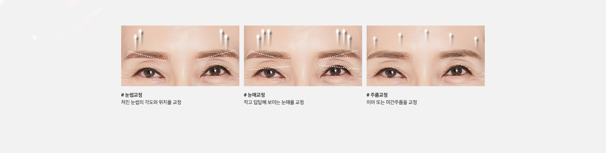 [내시경 이마거상술 교정 효과] # 눈썹교정 처진 눈썹의 각도와 위치를 교정 # 눈매교정 작고 답답해 보이는 눈매를 교정 # 주름교정 이마 또는 미간주름을 교정