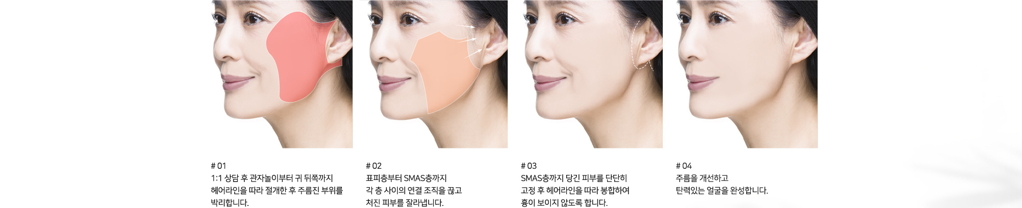 [안면거상술 수술방법] # 01 1:1 상담 후 관자놀이부터 귀 뒤쪽까지 헤어라인을 따라 절개한 후 처진 부위를 박리합니다. # 02 표피층부터 SMAS층까지 각 층 사이의 연결 조직을 끊고 처진 피부를 잘라냅니다. # 03 SMAS층까지 당긴 피부를 단단히 고정 후 헤어라인을 따라 봉합하여 흉이 보이지 않도록 합니다. # 04 주름을 개선하고 탄력있는 얼굴을 완성합니다.