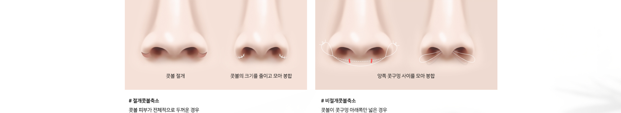 콧볼축소 수술방법 # 절개콧볼축소 콧볼 피부가 전체적으로 두꺼운 경우 콧볼 절개 후 콧볼의 크기를 줄이고 모아 봉합 # 비절개콧볼축소 콧볼이 콧구멍 아래쪽만 넓은 경우 양쪽 콧구멍 사이를 모아 봉합