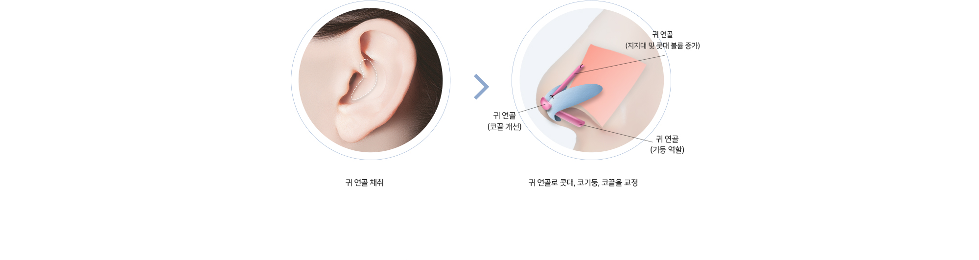 귀 연골 채취 > 귀 연골로 콧대, 코기둥, 코끝을 교정 (귀 연골 - 지지대 및 콧대 볼륨 증가 / 귀 연골 - 코끝 개선 / 귀 연골 - 기둥 역할)