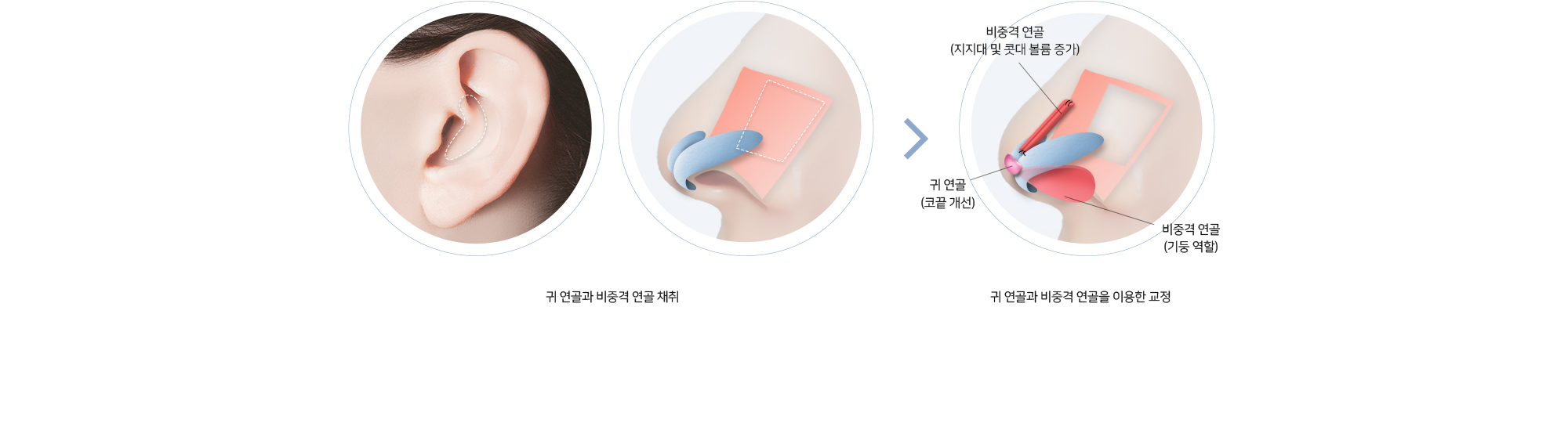 귀 연골과 비중격 연골 채취 > 귀 연골과 비중격 연골을 이용한 교정 (비중격 연골 - 지지대 및 콧대 볼륨 증가 / 귀 연골 - 코끝 개선 / 비중격 연골 - 기둥 역할)