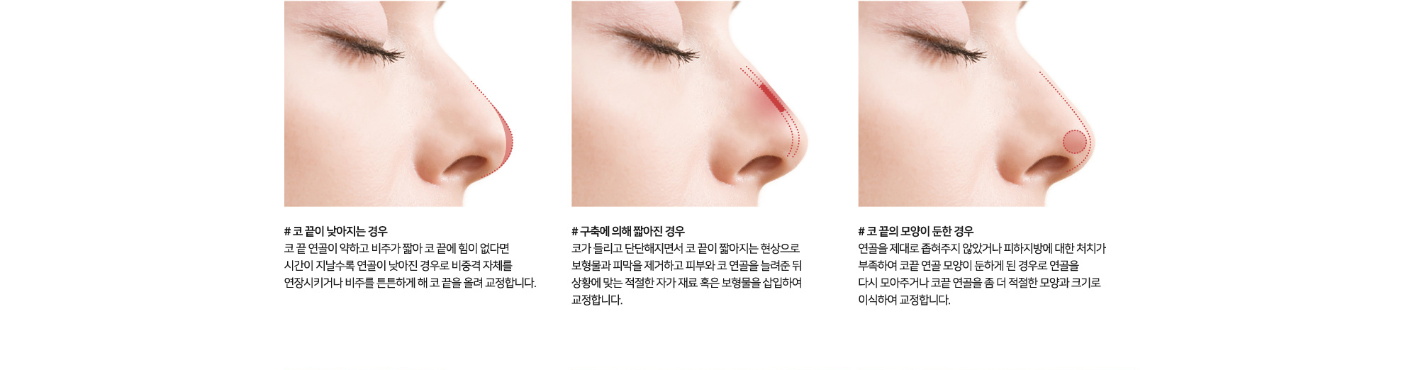 코 재수술 원인 및 치료방법 # 코끝이 낮아지는 경우 코끝 연골이 약하고 비주가 짧아 코 끝에 힘이 없다면 시간이 지날수록 연골이 낮아진 경우로 비중격 자체를 연장시키거나 비주를 튼튼하게 해 코 끝을 올려 교정합니다. # 구축에 의해 짧아진 경우 코가 들리고 단단해지면서 코 끝이 짧아지는 현상으로 보형물과 피부를 제거하고 연골을 늘려준 뒤 상황에 맞는 적절한 자가재료 혹은 보형물을 삽입하여 교정합니다. # 코끝의 모양이 둔한 경우 연골을 제대로 봉합하지 않았거나 피하지방에 대한 처치가 부족하여 코끝 연골 모양이 둔하게 된 경우로 연골을 다시 모아주거나 코끝 연골을 좀 더 적절한 모양과 크기로 이식하여 교정합니다.