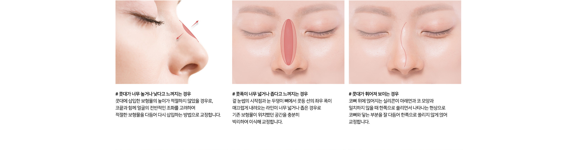 코 재수술 원인 및 치료방법 # 콧대가 너무 높거나 낮다고 느껴지는 경우 콧대에 삽입한 보형물의 높이가 적절하지 않았을 경우로, 코끝과 함께 연골의 전반적인 조화를 고려하여 적절한 보형물을 다듬어 다시 삽입하는 방법으로 교정합니다. # 콧폭이 너무 넓거나 좁다고 느껴지는 경우 겉 눈썹의 시작점과 눈 두덩이 뼈에서 콧등 선의 좌우 폭이 매끄럽게 내려오는 라인이 너무 넓거나 좁은 경우로 기존 보형물이 위치했던 공간을 충분히 박리하여 이식해 교정합니다. # 콧대가 휘어져 보이는 경우 코뼈 위에 얹어지는 실리콘이 아래연골과 그 모양과 일치하지 않을 때 한쪽으로 쏠리면서 나타나는 현상으로 코뼈와 닿는 부분을 잘 다듬어 한쪽으로 쏠리지 않게 얹어 교정합니다.
