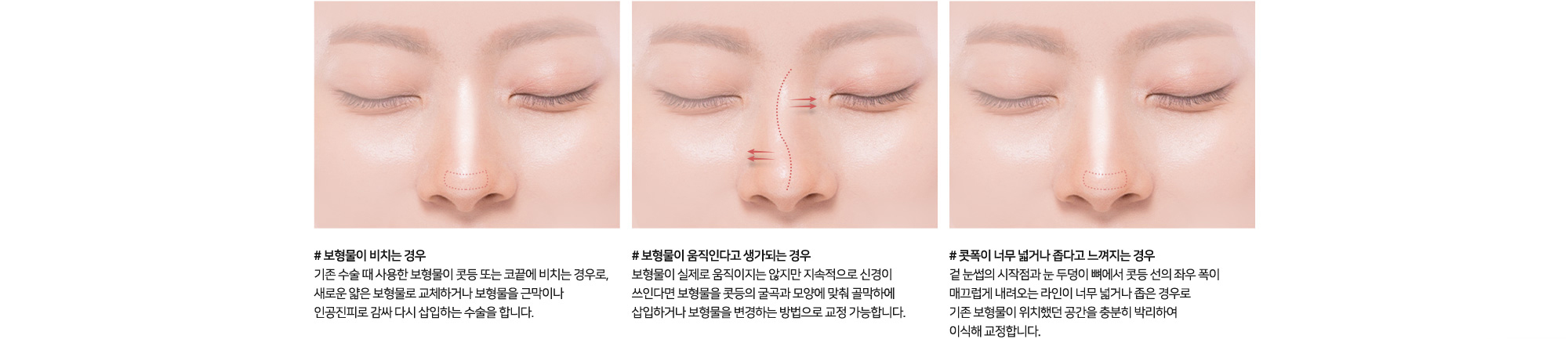 코 재수술 원인 및 치료방법 # 보형물이 비치는 경우 기존 수술 때 사용한 보형물이 콧등 또는 코끝에 비치는 경우로, 새로운 얇은 보형물로 교체하거나 보형물을 갈아내 인공진피로 감싸 다시 삽입하는 수술을 합니다. # 보형물이 움직인다고 생각되는 경우 보형물이 실제로 움직이지는 않지만 지속적으로 신경이 쓰인다면 보형물을 충분히 골막과 모양에 맞게 밀착하여 삽입하거나 보형물을 변경하는 방법으로 교정 가능합니다. # 콧폭이 너무 넓거나 좁다고 느껴지는 경우 겉 눈썹의 시작점과 눈 두덩이 뼈에서 콧등 선의 좌우 폭이 매끄럽게 내려오는 라인이 너무 넓거나 좁은 경우로 기존 보형물이 위치했던 공간을 충분히 박리하여 이식해 교정합니다.