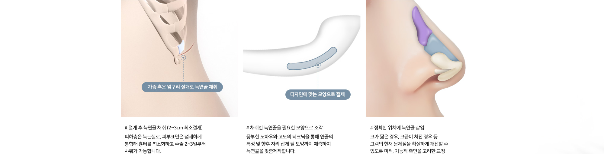 늑연골 코성형 수술정보 # 절개 후 늑연골 채취 (2~3cm 최소절개) 피하층은 녹는실로, 피부표면은 섬세하게 봉합해 흉터를 최소화하고 수술 2~3일부터 샤워가 가능합니다. # 채취한 늑연골을 필요한 모양으로 조각 풍부한 노하우와 고도의 테크닉을 통해 연골의 특성 및 향후 자리 잡게 될 모양까지 예측하여 늑연골을 맞춤제작합니다. # 정확한 위치에 늑연골 삽입 코가 짧은 경우, 코끝이 처진 경우 등 고객의 현재 문제점을 확실하게 개선할 수 있도록 미적, 기능적 측면을 고려한 교정