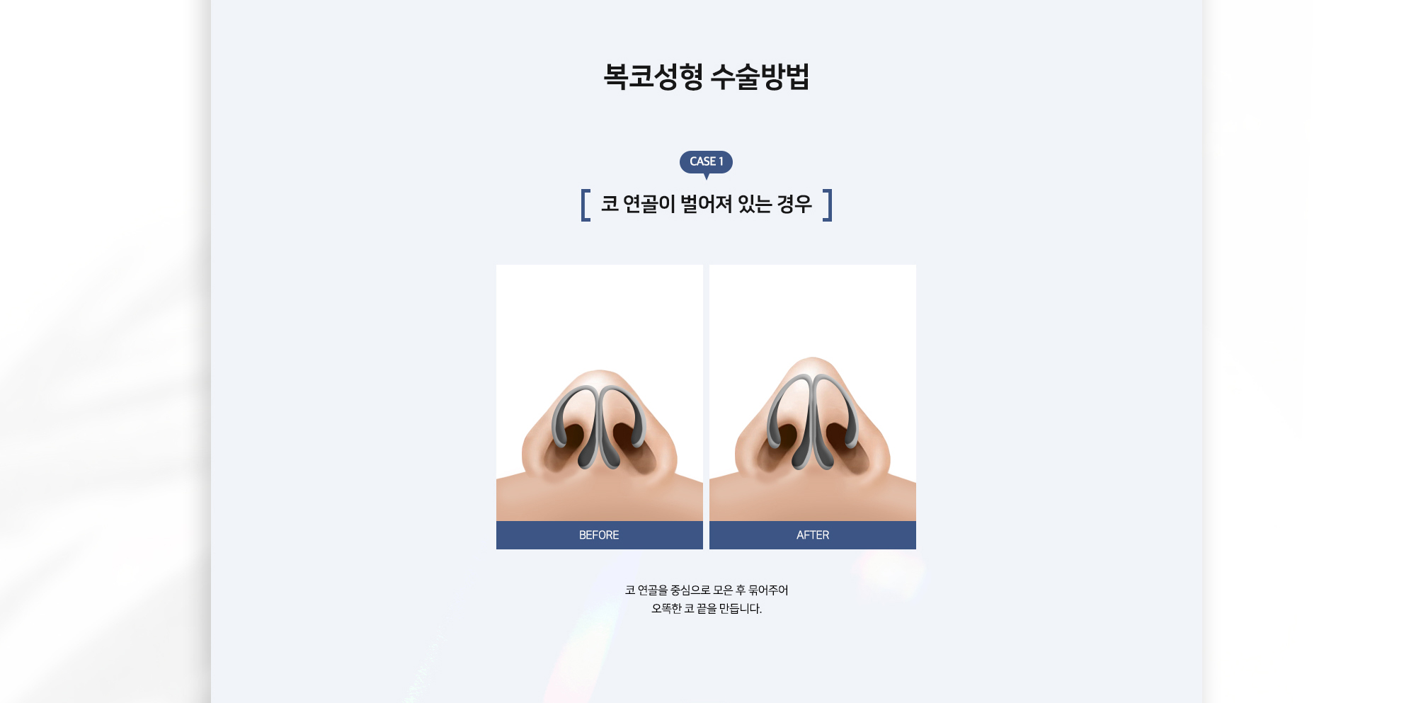복코성형 수술방법 CASE 1 코 연골이 벌어져 있는 경우 BEFORE AFTER 코 연골을 중심으로 모은 후 묶어주어 오뚝한 코끝을 만듭니다.