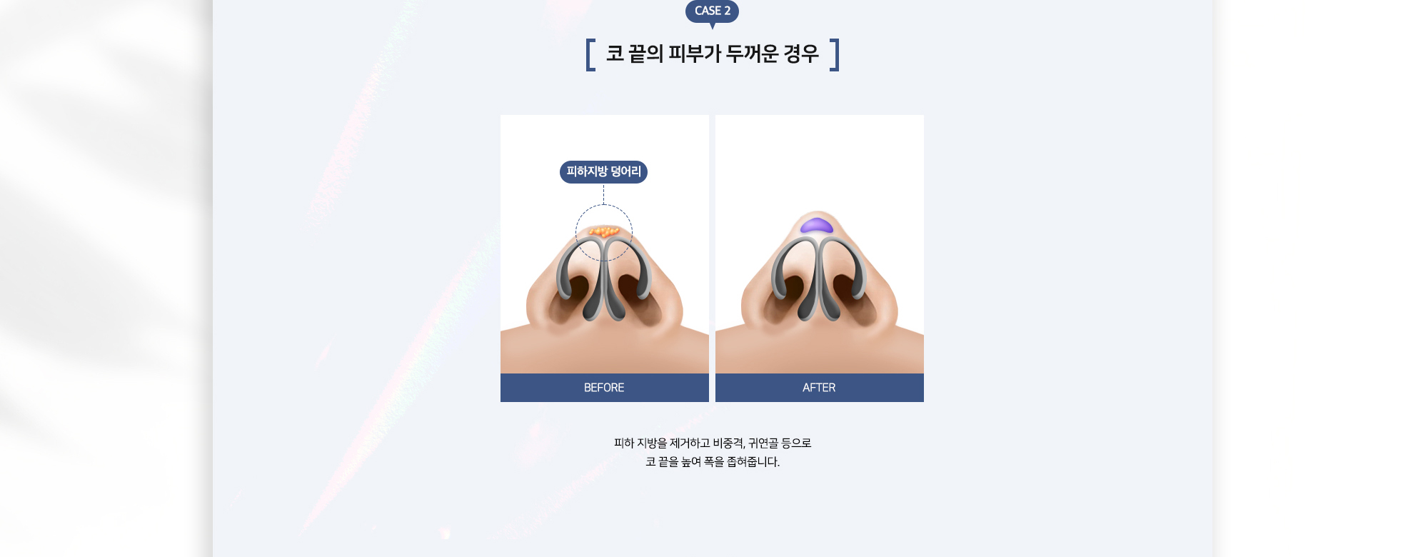 복코성형 수술방법 CASE 2 코 끝의 피부가 두꺼운 경우 피하지방 덩어리 BEFORE AFTER 피하 지방을 제거하고 비중격, 귀연골 등으로 코 끝을 높여 폭을 좁혀줍니다.