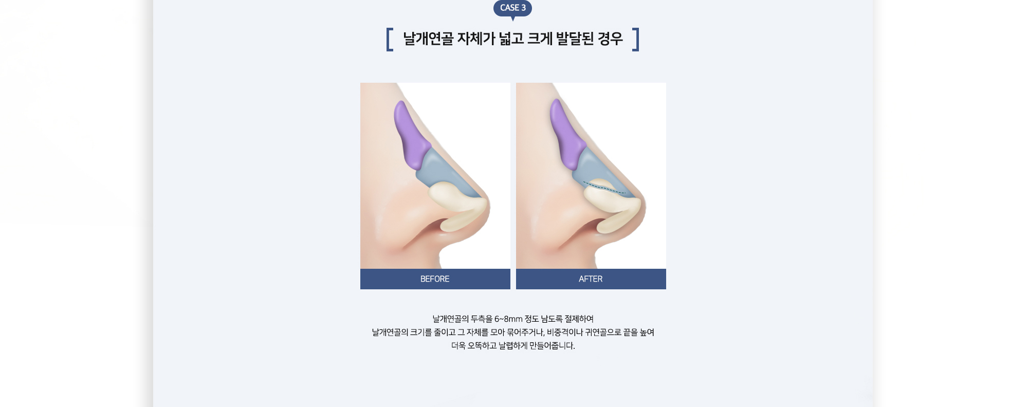 복코성형 수술방법 CASE 3 날개연골 자체가 넓고 크게 발달된 경우 BEFORE AFTER 날개연골의 두축을 6~8mm 정도 남도록 절제하여 날개연골의 크기를 줄이고 그 자체를 모아 묶어주거나, 비중격이나 귀연골으로 코끝을 높여 더욱 오뚝하고 날렵하게 만들어줍니다.