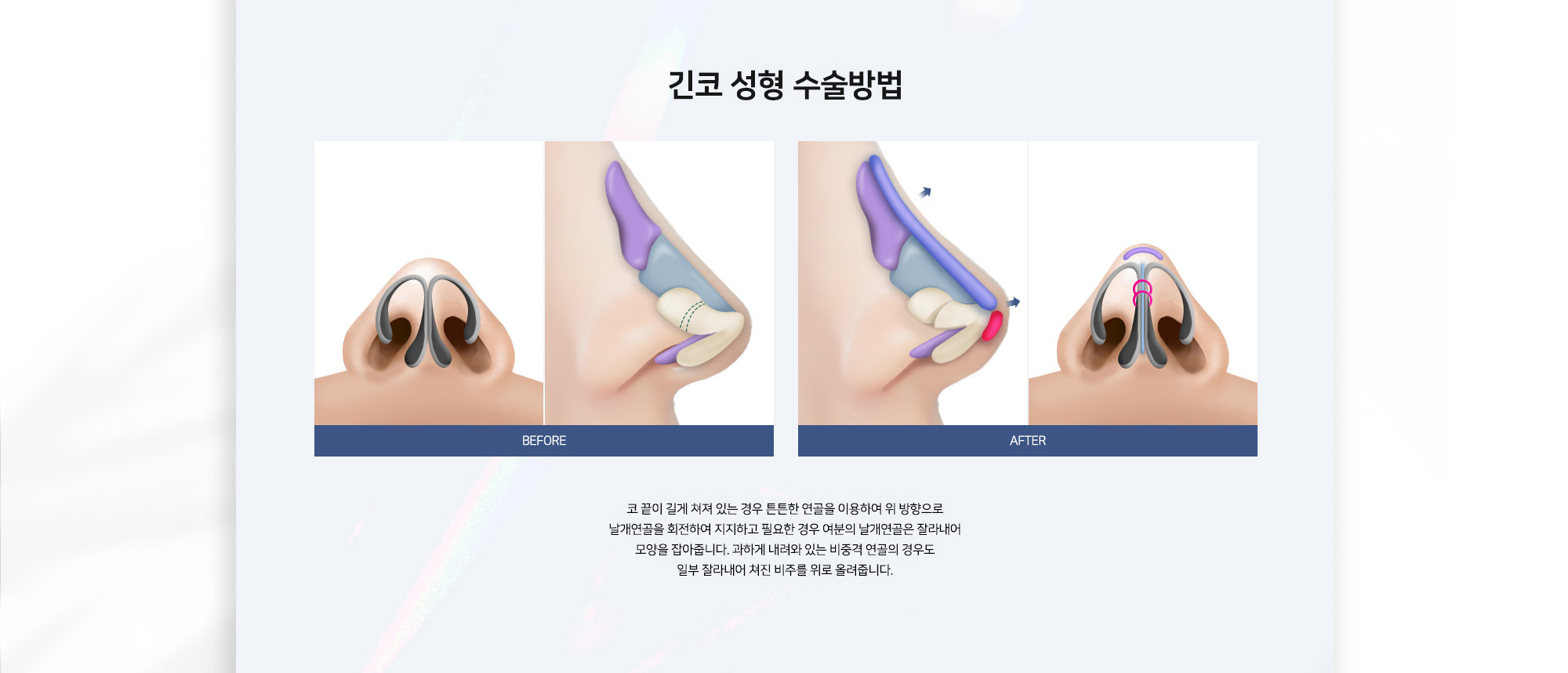 긴코 성형 수술방법 코 끝이 길게 처져 있는 경우 튼튼한 연골을 이용하여 위 방향으로 날개연골을 회전하여 지지하고 필요한 경우 여분의 날개연골은 잘라내어 모양을 잡아줍니다. 과하게 내려와 있는 비중격 연골의 경우도 일부 잘라내어 처진 비주를 위로 올려줍니다. BEFORE AFTER