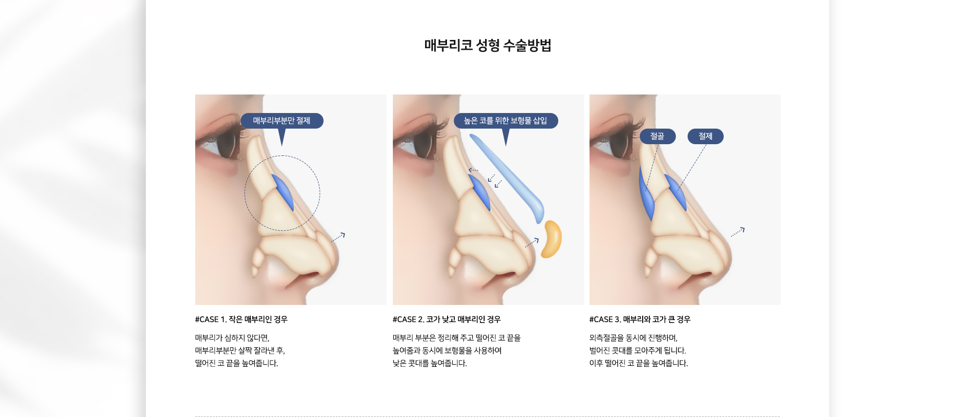 매부리코 성형 수술방법 #CASE 1. 작은 매부리인 경우 매부리가 심하지 않다면 매부리 부분만 살짝 잘라낸 후 떨어진 코 끝을 높여줍니다. #CASE 2. 코가 낮고 매부리인 경우 매부리 부분은 정리해 주고 떨어진 코 끝을 높여줌과 동시에 보형물을 사용하여 낮은 콧대를 높여줍니다. #CASE 3. 매부리와 코가 큰 경우 외측절골을 동시에 진행하며 벌어진 콧대를 모아주게 됩니다. 이후 떨어진 코 끝을 높여줍니다.