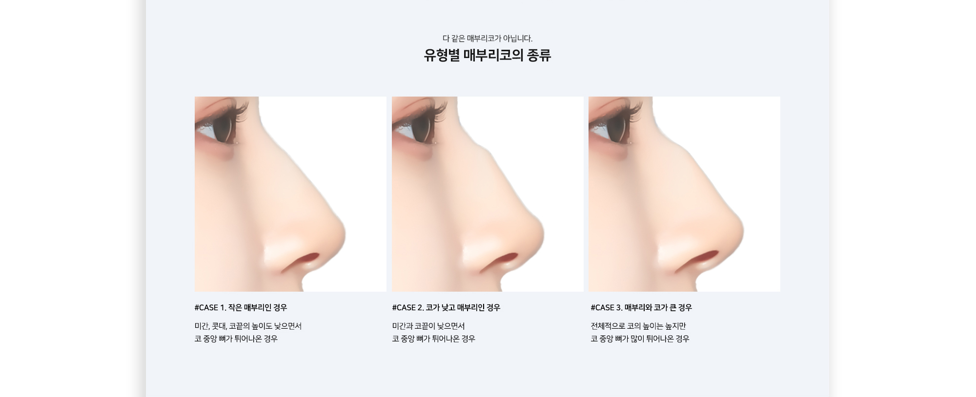 다 같은 매부리코가 아닙니다. 유형별 매부리코의 종류 #CASE 1. 작은 매부리인 경우 미간, 콧대, 코끝의 높이도 낮으면서 코 중앙 뼈가 튀어나온 경우 #CASE 2. 코가 낮고 매부리인 경우 미간과 코끝이 낮으면서 코 중앙 뼈가 튀어나온 경우 #CASE 3. 매부리와 코가 큰 경우 전체적으로 코의 높이는 높지만 코 중앙 뼈가 많이 튀어나온 경우