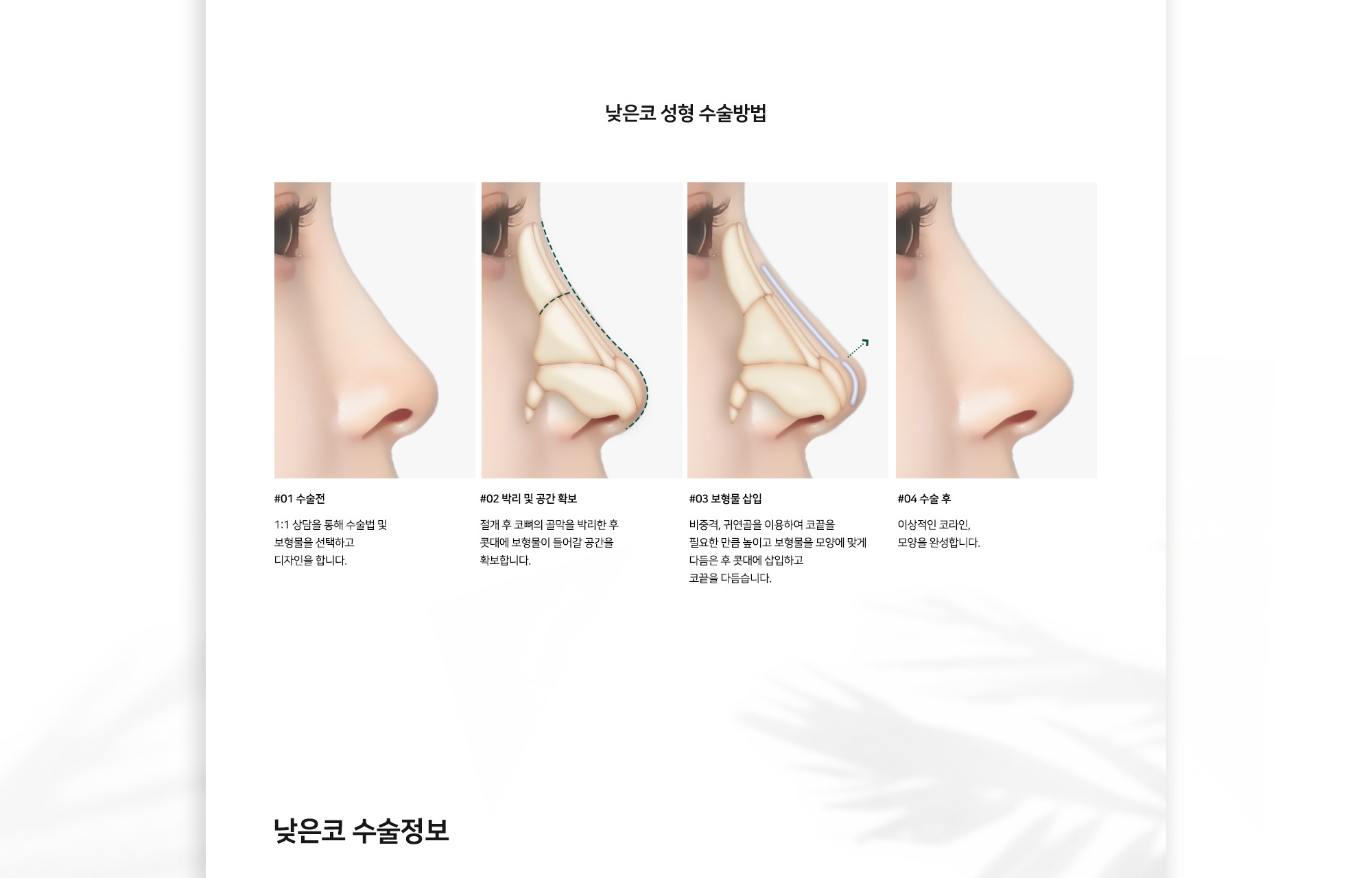 낮은코 성형 수술방법 #01 수술전 1:1 상담을 통해 수술법 및 보형물을 선택하고 디자인을 합니다. #02 박리 및 공간 확보 절개 후 코뼈의 골막을 박리한 후 콧대에 보형물이 들어갈 공간을 확보합니다. #03 보형물 삽입 비중격, 귀연골을 이용하여 코끝을 필요한 만큼 높이고 보형물을 모양에 맞게 다듬은 후 콧대에 삽입하고 코끝을 다듬습니다. #04 수술 후 이상적인 코라인, 모양을 완성합니다.