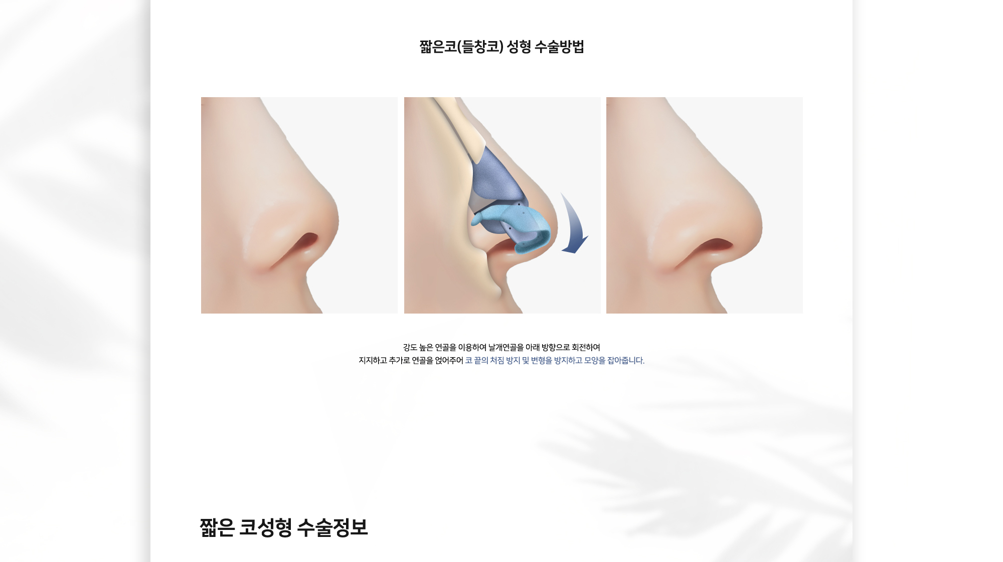짧은코(들창코) 성형 수술방법 강도 높은 연골을 이용하여 날개연골을 아래 방향으로 회전하여 지지하고 추가로 연골을 덧대주어 코 끝의 처짐 방지 및 변형을 방지하고 모양을 잡아줍니다.