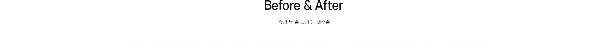Before & After - 슈가 두 줄 따기 눈 재수술