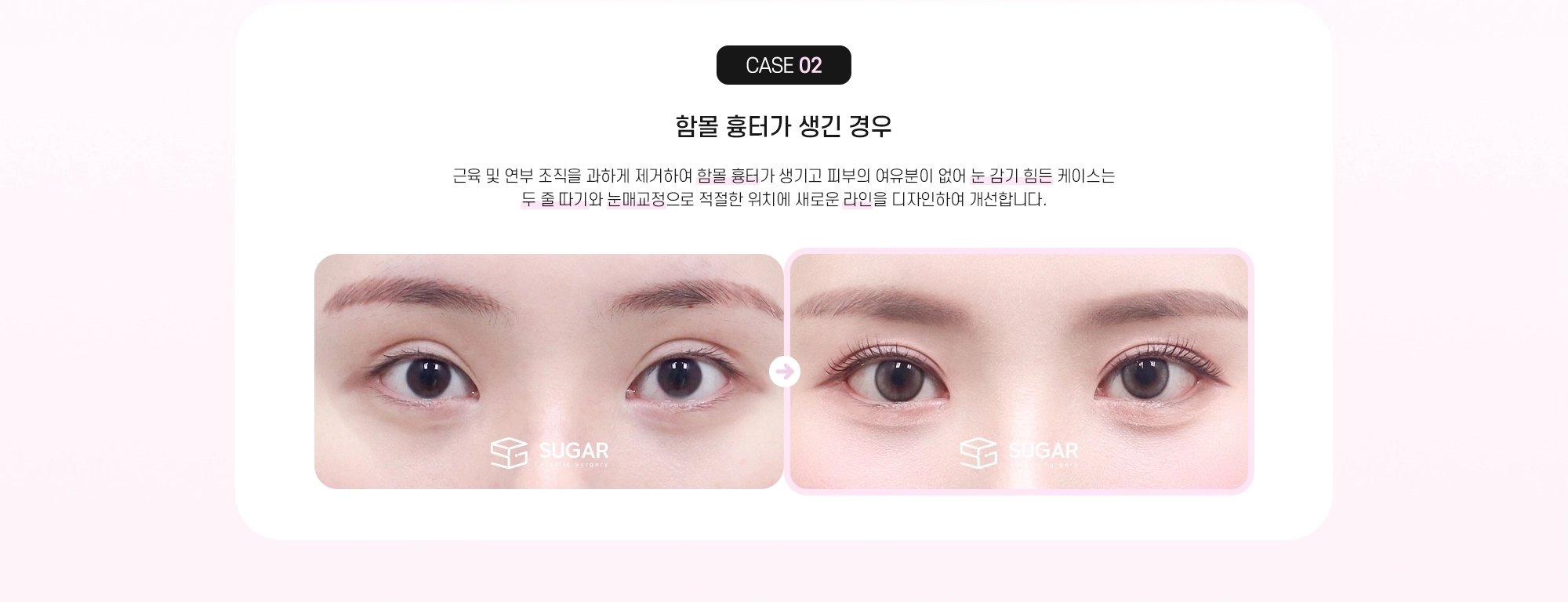 CASE 02 함몰 흉터가 생긴 경우 - 근육 및 연부 조직을 과하게 제거하여 함몰 흉터가 생기고 피부의 여유분이 없어 눈 감기 힘든 케이스는 두 줄 따기와 눈매교정으로 적절한 위치에 새로운 라인을 디자인하여 개선합니다.