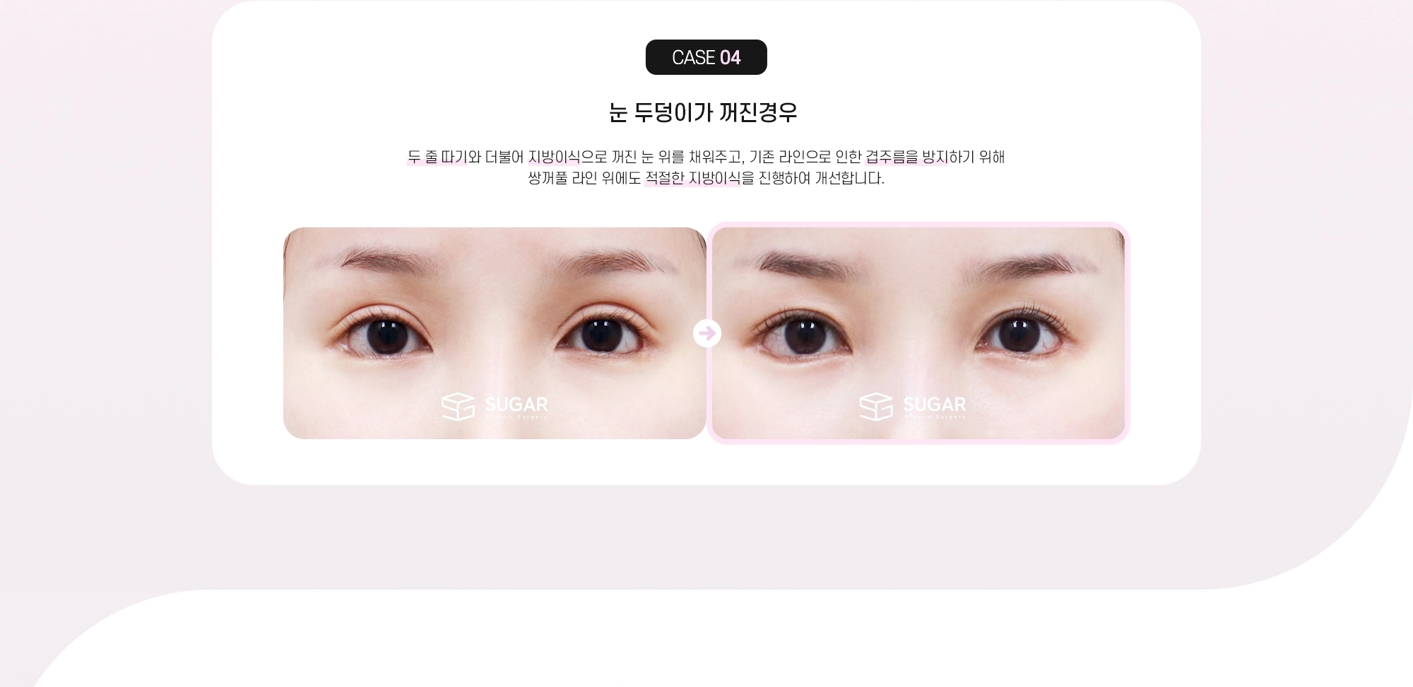 CASE 04 눈 두덩이가 꺼진 경우 - 두 줄 따기와 더불어 지방이식으로 꺼진 눈 위를 채워주고, 기존 라인으로 인한 겹주름을 방지하기 위해 쌍꺼풀 라인 위에도 적절한 지방이식을 진행하여 개선합니다.