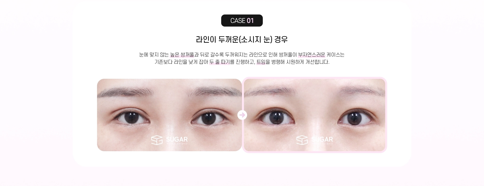 CASE 01 라인이 두꺼운(소시지 눈) 경우 - 눈에 맞지 않는 높은 쌍꺼풀과 뒤로 갈수록 두꺼워지는 라인으로 인해 쌍꺼풀이 부자연스러운 케이스는 기존보다 라인을 낮게 잡아 두 줄 따기를 진행하고, 트임을 병행해 시원하게 개선합니다.