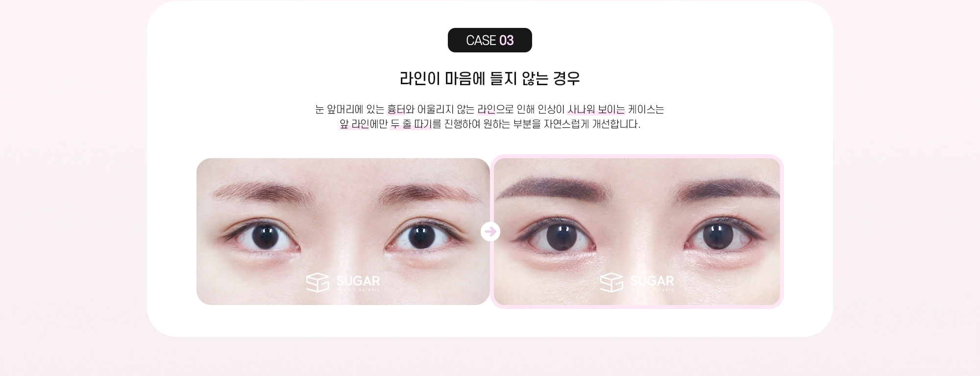 CASE 03 라인이 마음에 들지 않는 경우 - 눈 앞머리에 있는 흉터와 어울리지 않는 라인으로 인해 인상이 사나워 보이는 케이스는 앞 라인에만 두 줄 따기를 진행하여 원하는 부분을 자연스럽게 개선합니다.