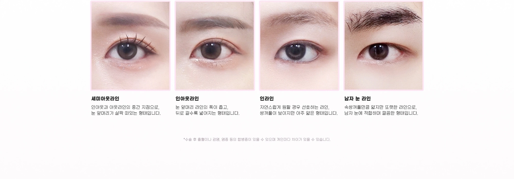 세미아웃라인: 인아웃과 아웃라인의 중간 지점으로, 눈 앞머리가 살짝 떠있는 형태입니다. 인아웃라인: 눈 앞머리 라인의 폭이 좁고, 뒤로 갈수록 넓어지는 형태입니다. 인라인: 자연스럽게 원할 경우 선호하는 라인, 쌍꺼풀이 보이지만 아주 얇은 형태입니다. 남자 눈 라인: 속쌍꺼풀만큼 얇지만 또렷한 라인으로, 남자 눈에 적합하며 깔끔한 형태입니다. *수술 후 출혈이나 감염, 염증 등의 합병증이 있을 수 있으며 개인마다 차이가 있을 수 있습니다.