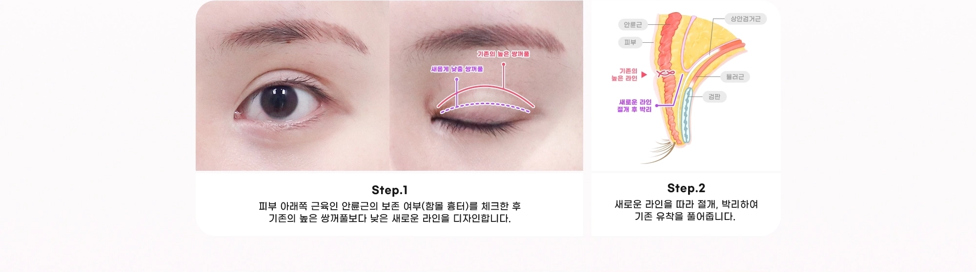 Step.1 피부 아래쪽 근육인 안륜근의 보존 여부(함몰 흉터)를 체크한 후 기존의 높은 쌍꺼풀보다 낮은 새로운 라인을 디자인합니다. Step.2 새로운 라인을 따라 절개, 박리하여 기존 유착을 풀어줍니다.